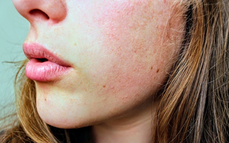 Bisa Menyerang di Segala Usia, Yuk Kenali Dermatitis Atopik