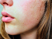 Bisa Menyerang di Segala Usia, Yuk Kenali Dermatitis Atopik