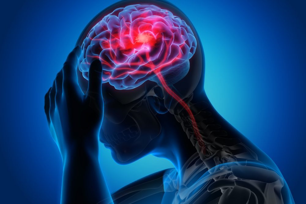 serangan stroke