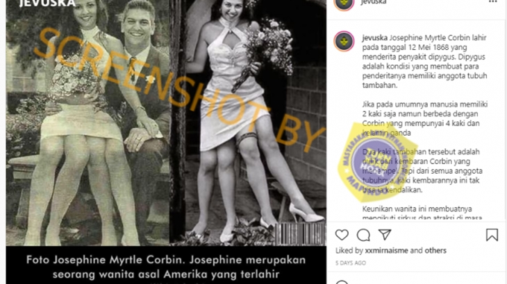 [HOAKS atau FAKTA]: Foto Josephine Myrtle Corbin, Wanita yang Miliki Empat Kaki