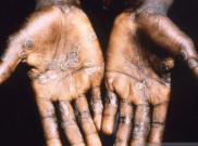 [HOAKS atau FAKTA]: AIDS Jenis Baru Campuran COVID-19 dan Cacar Monyet