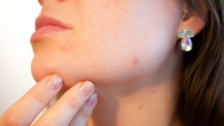 Pakai Skincare Setelah Masalah Jerawat Teratasi