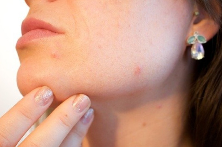 Pakai Skincare Setelah Masalah Jerawat Teratasi