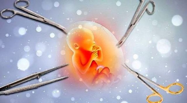Ilustrasi aborsi. (Foto: Net)