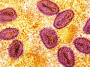 Tangani Kasus Mpox di Afrika, UNICEF Ajukan Dana 16,5 Juta Dolar AS
