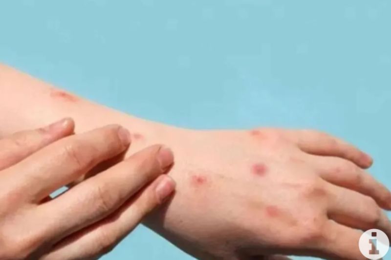 Afghanistan Cari Bantuan Atasi Penyebaran Mpox