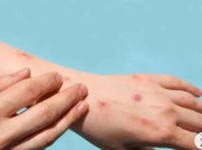 Cara Biar Terhindar Dari Penyakit Zoonosis