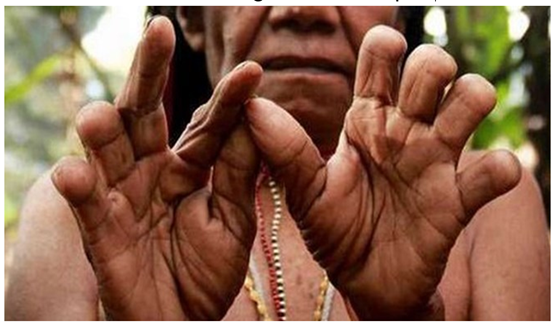 Tradisi Ekstrem Potong Jari 'Iki Palek' Suku Dani Papua, Tebus Duka Kehilangan Mendalam 