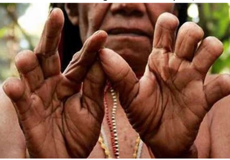 Tradisi Ekstrem Potong Jari 'Iki Palek' Suku Dani Papua, Tebus Duka Kehilangan Mendalam
