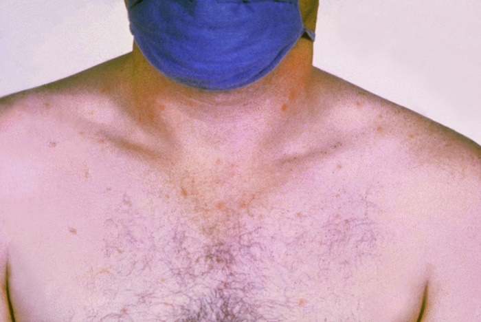 Tifoid