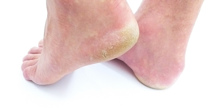 Trivia1: beri lotion pada tumit yang kering atau mengelupas: foto: PIxabay/COSA_NOSTRA)