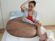 Tumor Seberat 95 kg Berhasil Dibuang