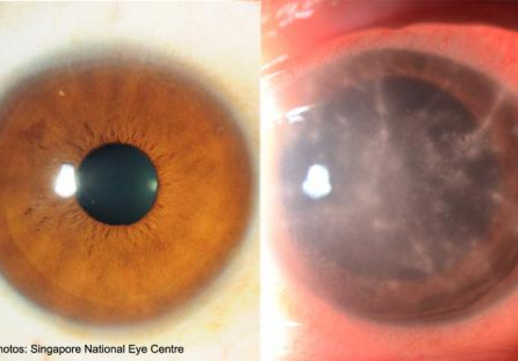 Bahaya Dibalik Cantiknya Lensa Kontak Berwarna