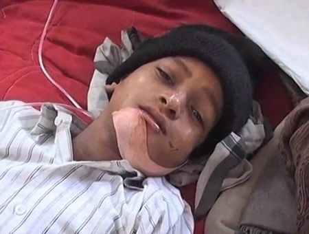Seorang Anak Cabut 80 Giginya
