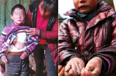 Menderita Penyakit Kulit Langka, Bocah Ini Dibungkus Tisu