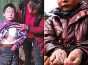 Menderita Penyakit Kulit Langka, Bocah Ini Dibungkus Tisu