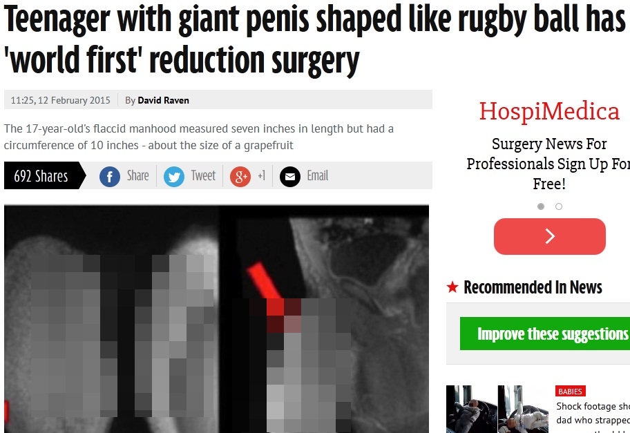 Operasi Pengecilan Penis Pertama di Dunia