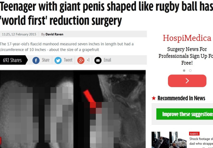 Operasi Pengecilan Penis Pertama di Dunia
