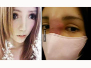 Operasi Plastik Buat Hidung Gadis Membusuk
