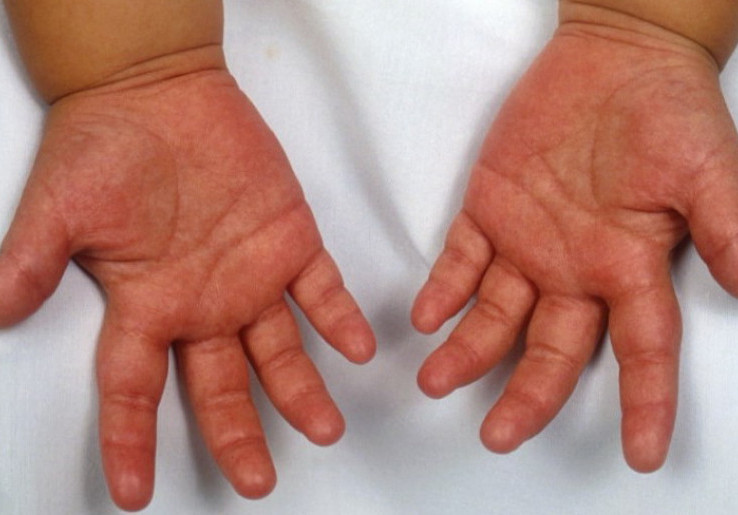 Waspada, Penyakit Kawasaki Serang Anak