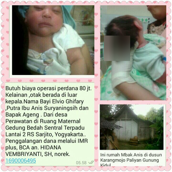 Kisah Miris Bayi Elvio, Penderita Kelainan Otak