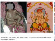Miliki 4 Kaki, Bayi Ini Dianggap Titisan Dewa Ganesha