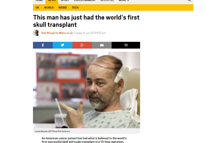 Pria AS Jalani Transplantasi Tengkorak Pertama di Dunia