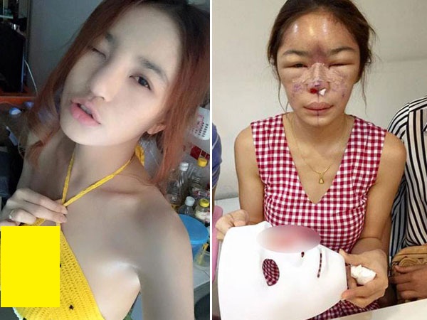 Wajah Wanita Ini Hancur Berantakan Setelah Operasi Plastik