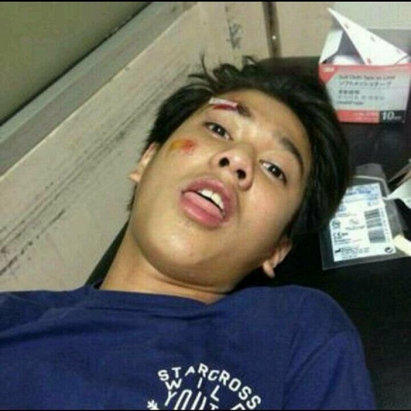 Iqbaal CJR Kecelakaan Motor dan Alami Patah Tulang