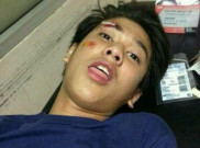 Iqbaal CJR Kecelakaan Motor dan Alami Patah Tulang