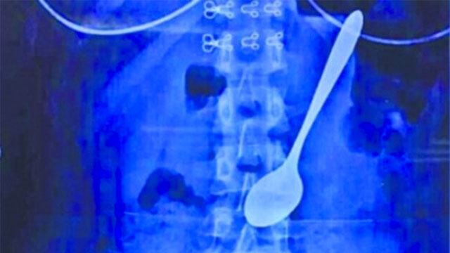 Dokter di Tiongkok Keluarkan Sendok dari Tubuh Mahasiswi