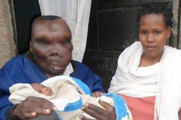 Pria Terjelek di Uganda, 2 Kali Menikah dan Punya 8 Anak