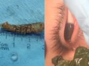 Ada Cacing Hidup di Mata Remaja Ini