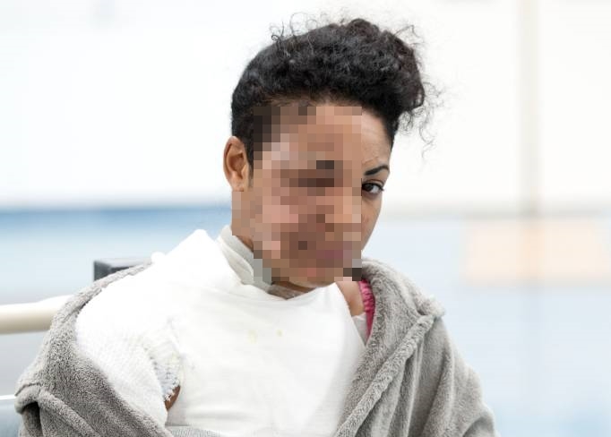 Blender Meledak, Wanita Ini Alami Luka Bakar di Wajah