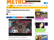 Wanita India Melahirkan Bayi Kembar Siam