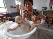 Miris, Tak Punya Anus Bayi Ini Hidup Seperti Tengkorak