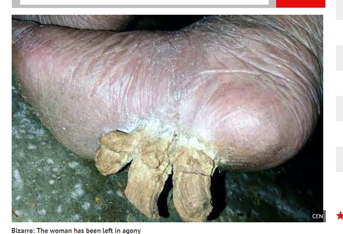 Mengerikan, Kuku Tumbuh dari Telapak Kaki Seorang Nenek