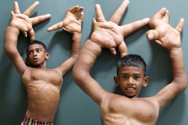 Punya Tangan Raksasa, Bocah 8 Tahun Dijuluki 'Hantu'