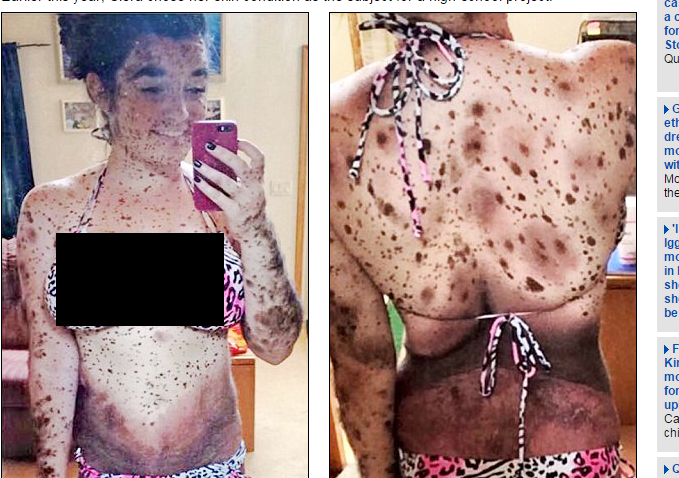 Sekujur Tubuh Gadis Ini Dipenuhi Tanda Lahir
