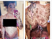 Sekujur Tubuh Gadis Ini Dipenuhi Tanda Lahir