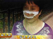 Kesal, Suami Tega Gigit Hidung Istri Hingga Putus