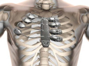 3D Printing Selamatkan Penderita Tumor Dinding Dada