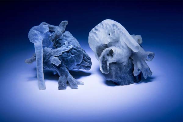 Print 3D Digunakan untuk Lihat Jantung Pasien