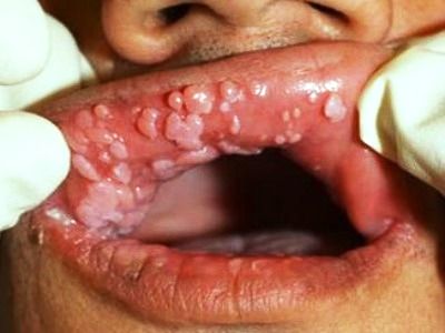 HPV, Penyakit Kulit Kelamin yang Mengerikan