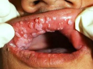 HPV, Penyakit Kulit Kelamin yang Mengerikan