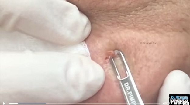 Jangan Pencet Jerawat Sembarangan, Tanya Ahlinya 