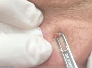 Jangan Pencet Jerawat Sembarangan, Tanya Ahlinya 