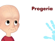 Apa Itu Progeria? Penyakit Genetik Langka dengan Dampak Penuaan Dini