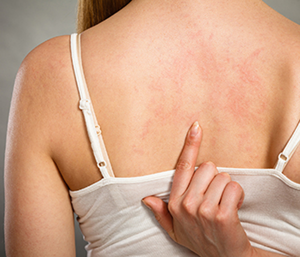 skin rash