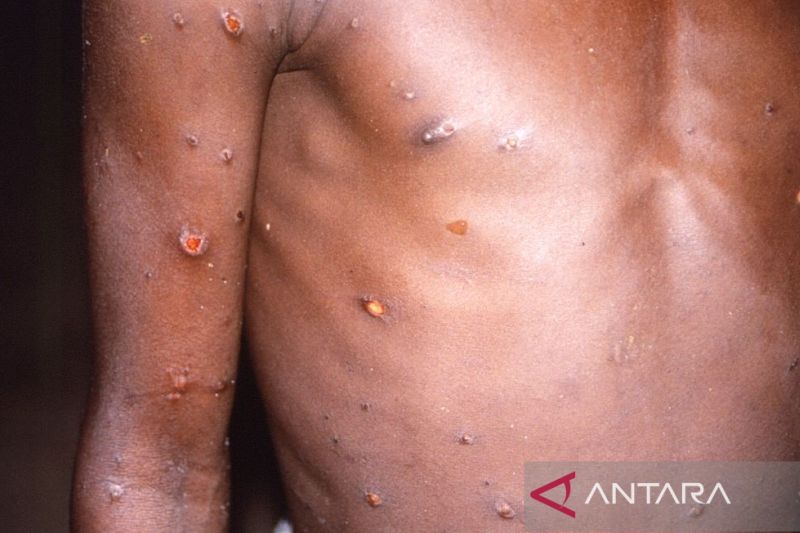 Lengan dan dada seorang pasien dengan lesi kulit akibat cacar monyet, dalam gambar tak bertanggal yang diperoleh Reuters pada 18 Mei 2022. (CDC/Brian W.J. Mahy/HO via Reuters/as)